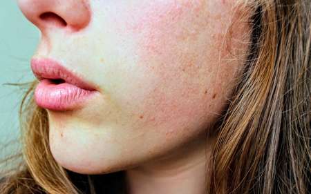 Чем можно вылечить аллергию на шее